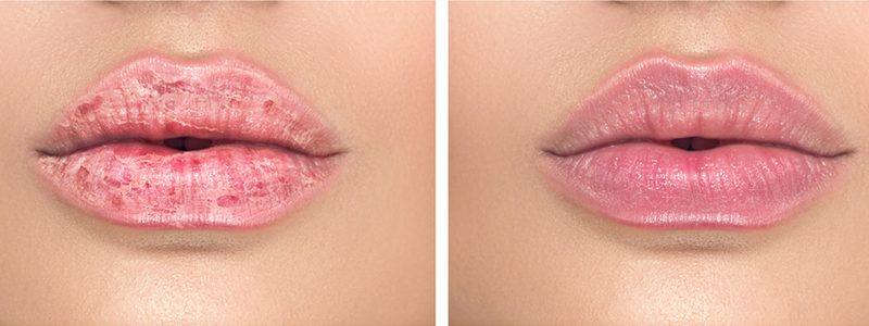 Droge lippen bij een vrouw.