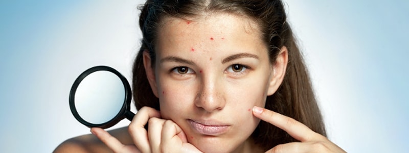 Een tiener met veel acne.