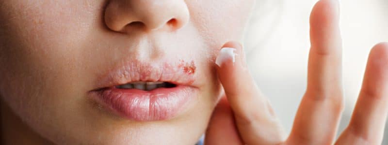 Koortsblaas op de lip van een vrouw.
