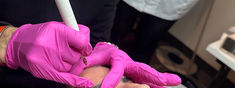 plasma lifting